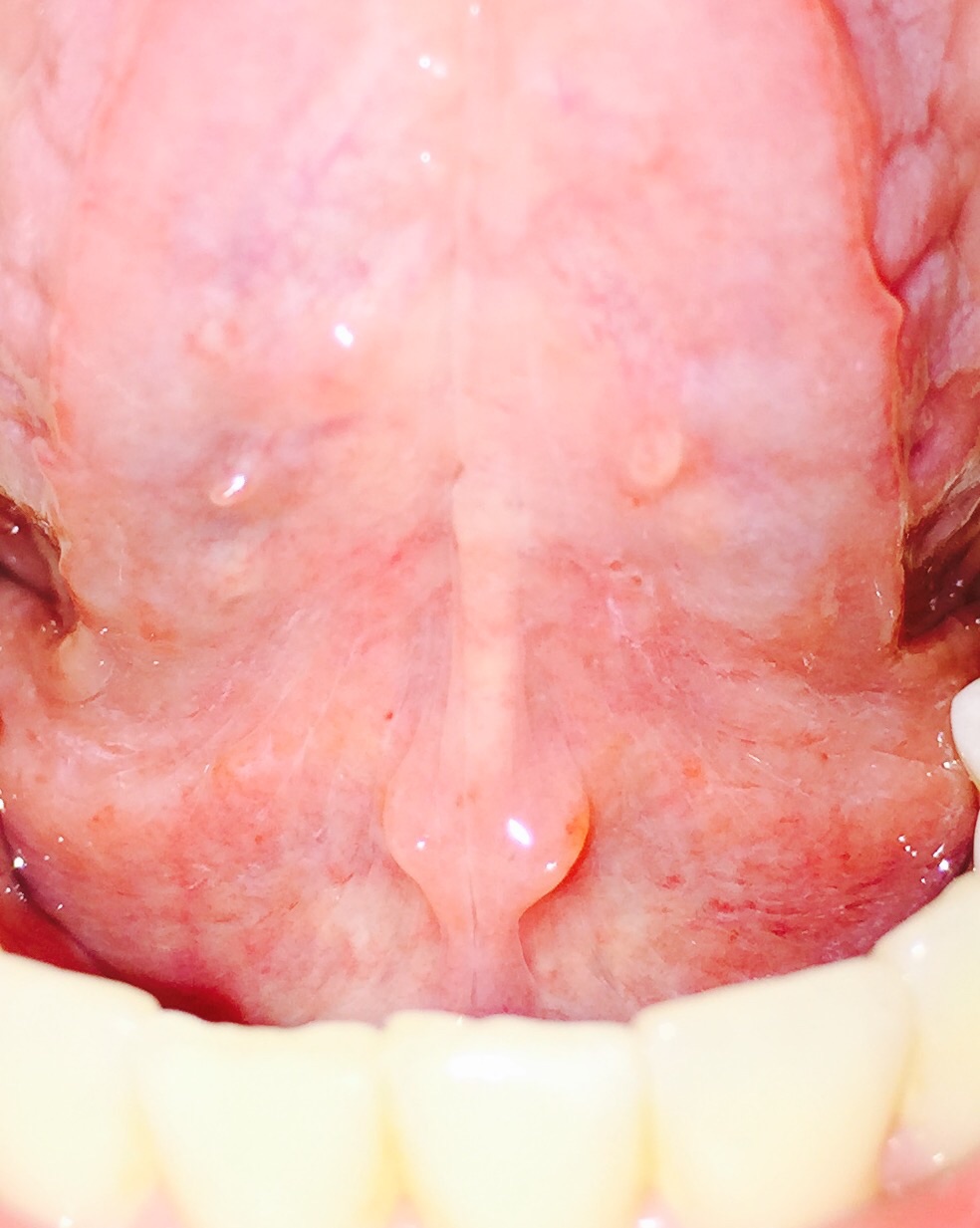 Unter der Zunge ein Knubbel und Taubheitsgefühl (Gesundheit